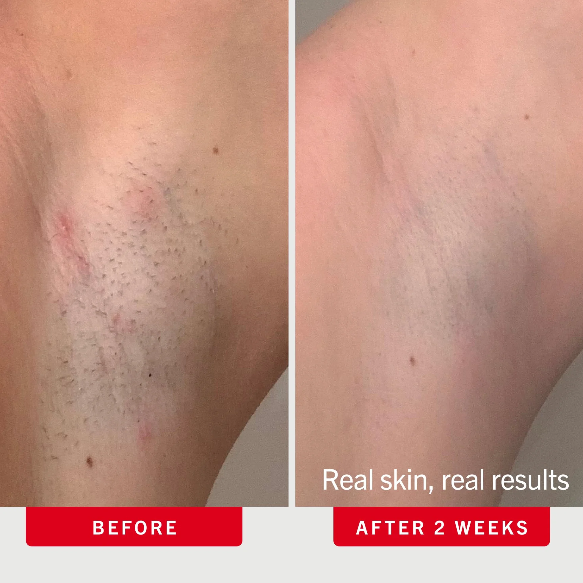 First Aid Beauty Cuscinetti incarniti con BHA e AHA - Trattamento quotidiano - Allevia le ustioni da rasoio, previene i peli incarniti e lenisce le irritazioni - 28 tamponi