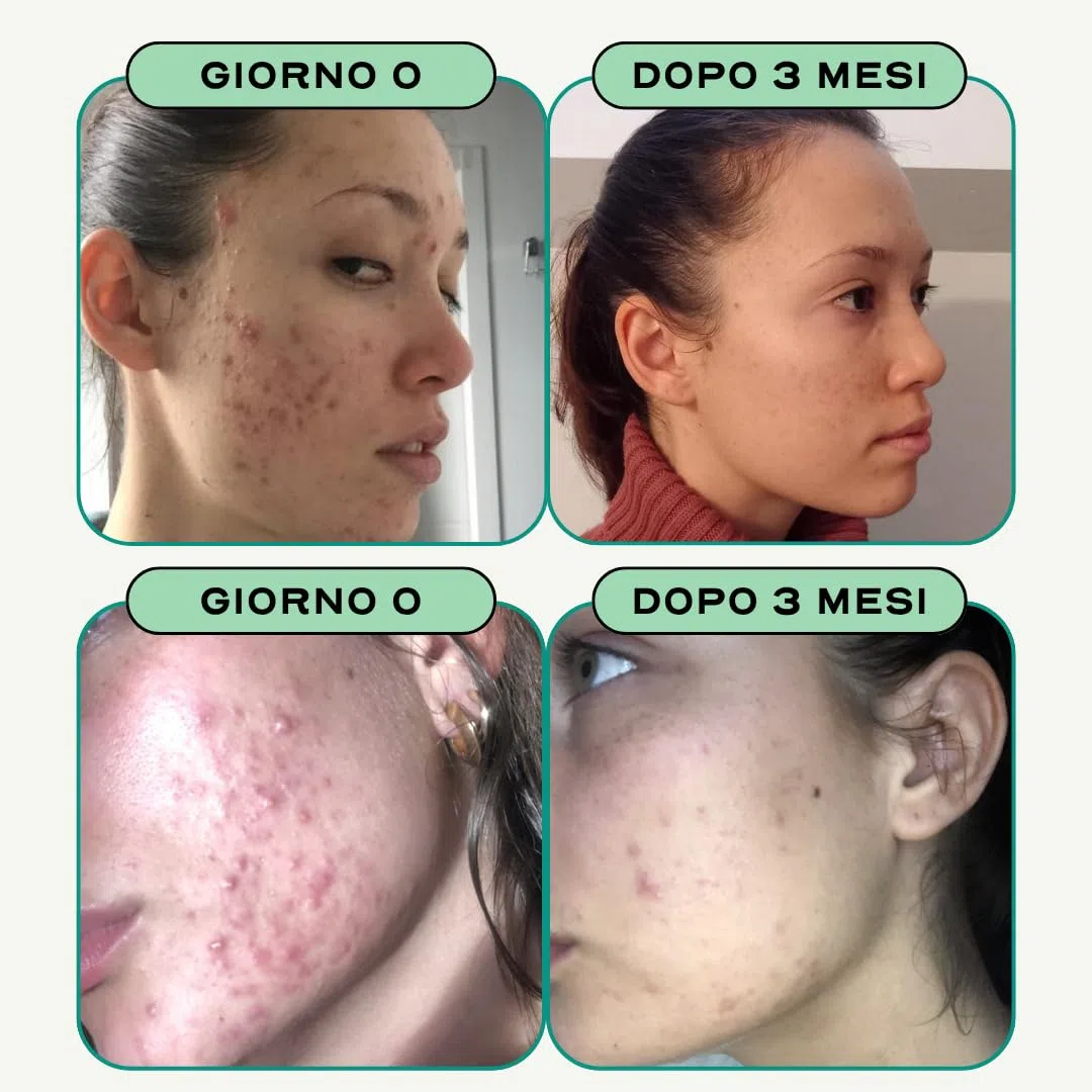 Circles CLEAR Integratore Donna Acne Ormonale - Zinco + Bardana Ortica Curcuma Rosmarino - Equilibrio Ormonale Post-Pillola Ciclo - Pelle Impura Imperfezioni - 60 Capsule Vegan Senza Glutine (1)