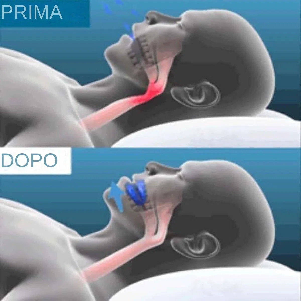 RinovaX - Bite anti-russamento silenzioso universale (1 pezzi)