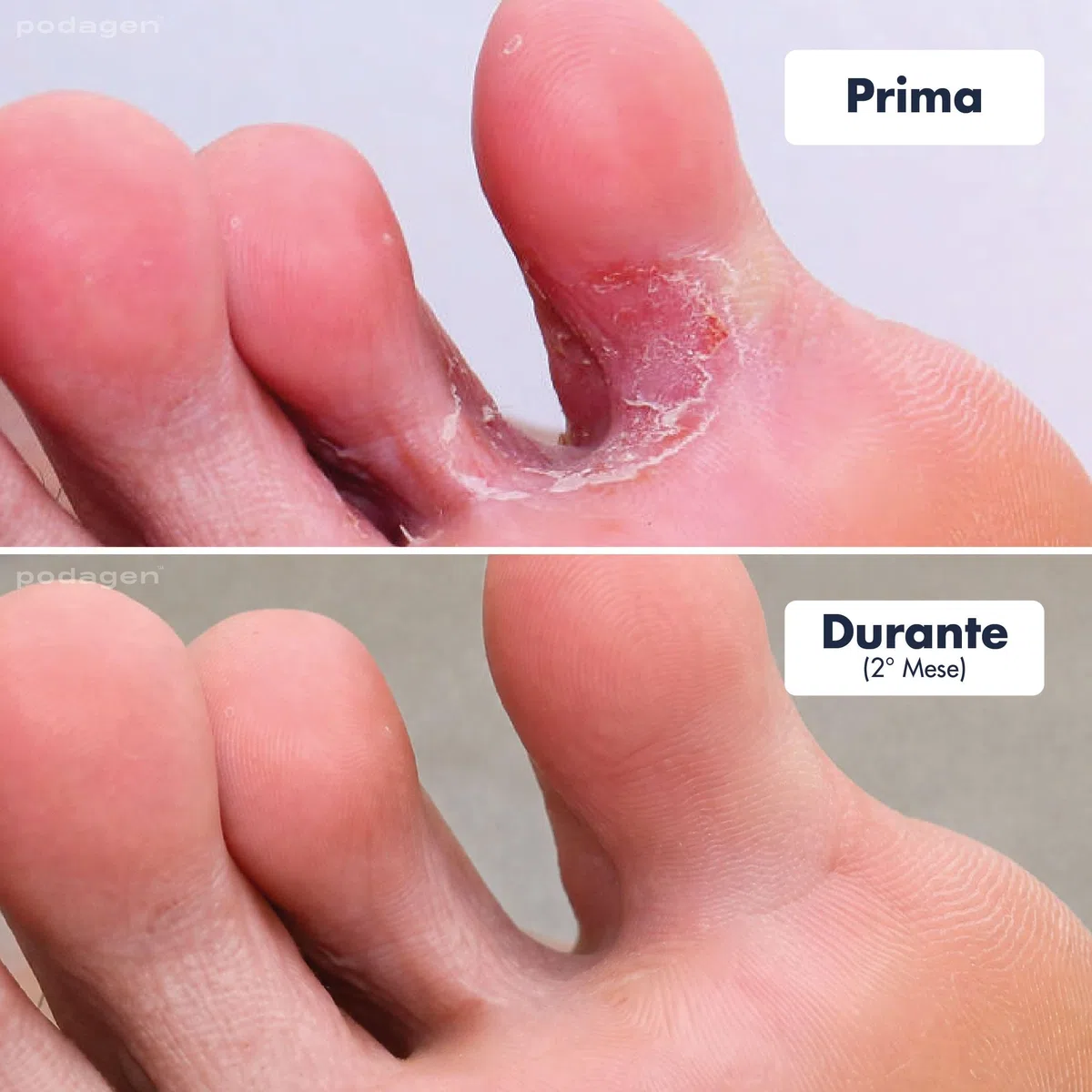 podagen piedi, 2/4/8 Pezzi Penna Cura Piedi Donna con Pennello Integrato Cura Unghie Piedi Formula ad Asciugatura Rapida Applicazione Precisa Portatile per Uso Quotidiano