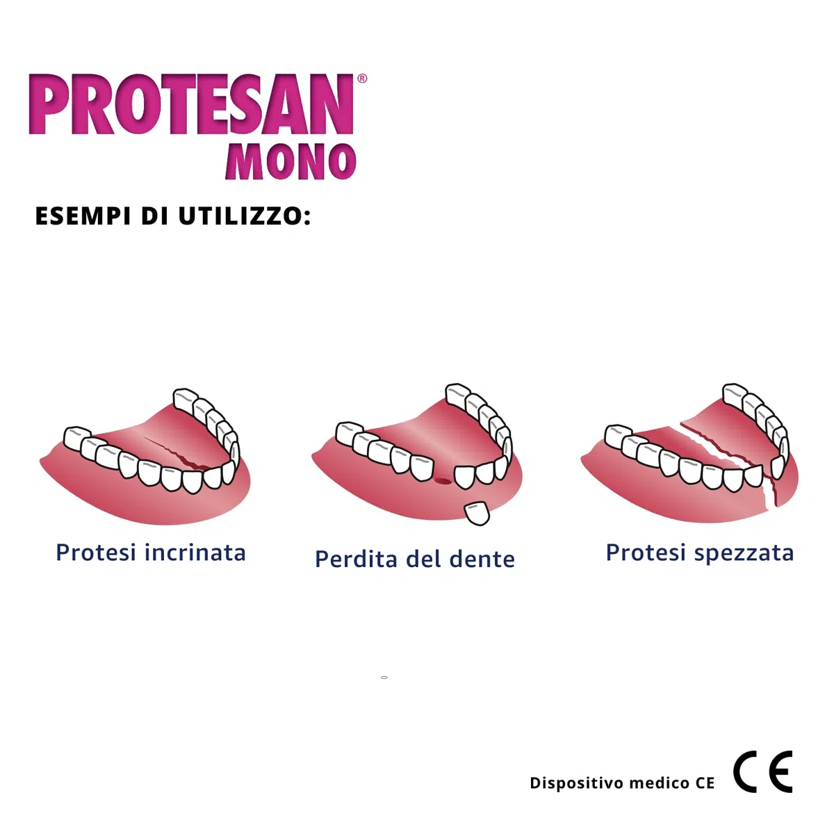 Protesan Mono - Riparatore per Dentiere Spezzate, Incrinate o Che Hanno Perso un Dente
